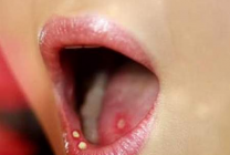 4 cách điều trị viêm loét miệng lưỡi tại nhà từ thiên nhiên